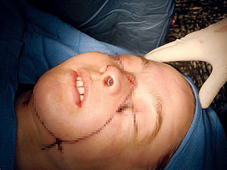 Face Transplant Patient Speaks Out