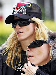 Madonna Bruised By Paparazzi