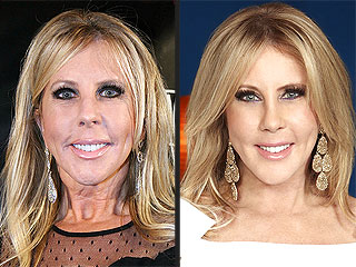 Real Housewives of Orange County: Vicki Gunvalson Reveals Post-Plastic Surgery Face