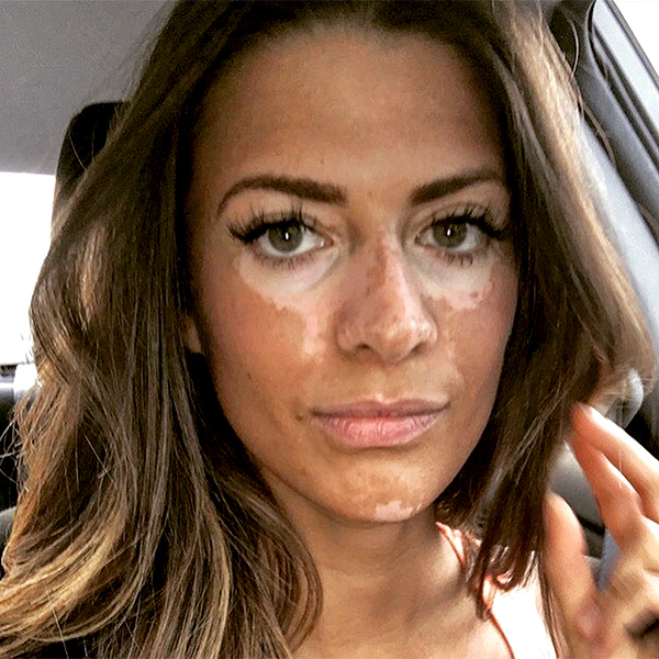 Former Model Breanne Rice Is Done With Hiding Her Vitiligo