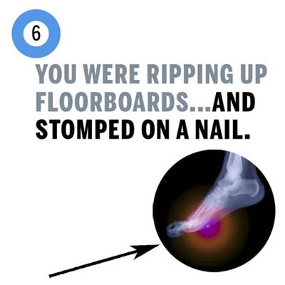 you stomped on a nail