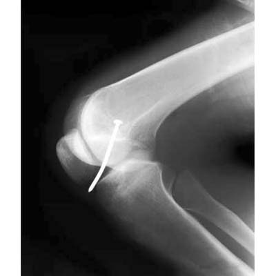 nail gun injury in knee