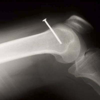 nail gun injury in mouth